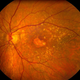 A retina with macular degeneration. (Image: University of Iowa)